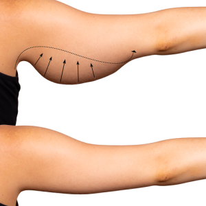 arm-lift
